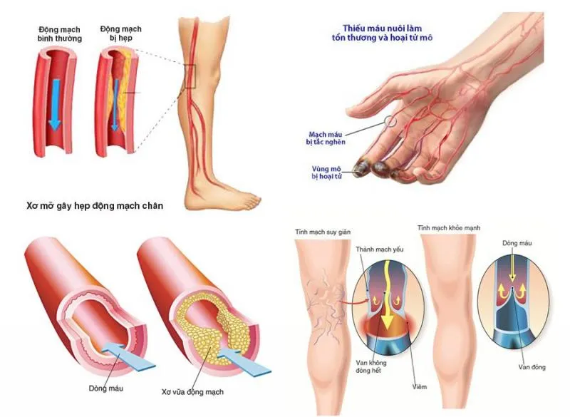 Top 6 Địa chỉ khám và điều trị suy giãn tĩnh mạch uy tín nhất Hà Nội