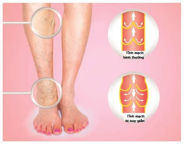 Top 6 Địa chỉ khám và điều trị suy giãn tĩnh mạch uy tín nhất Hà Nội