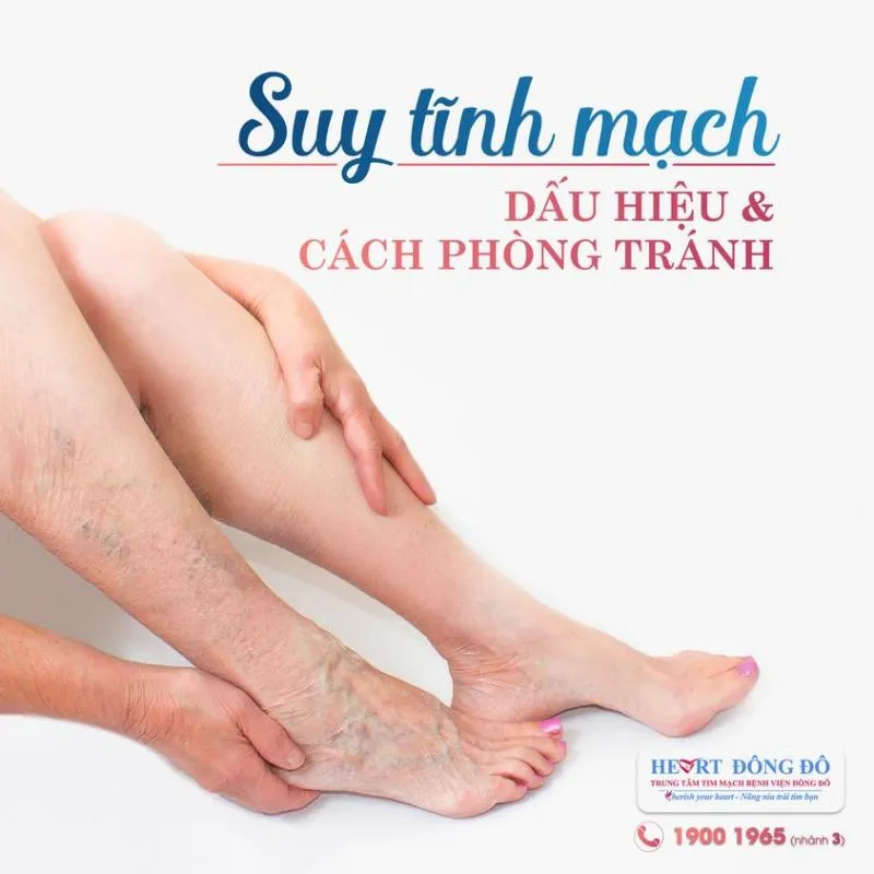 Top 6 Địa chỉ khám và điều trị suy giãn tĩnh mạch uy tín nhất Hà Nội