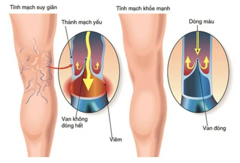 Top 6 Địa chỉ khám và điều trị suy giãn tĩnh mạch uy tín nhất Hà Nội